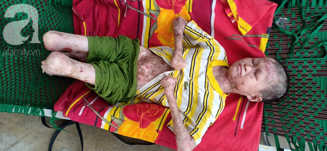 Tâm sự đau đớn của người rắn” 17 tuổi: Em còn sống ngày nào thì cha mẹ còn khổ thêm”-1