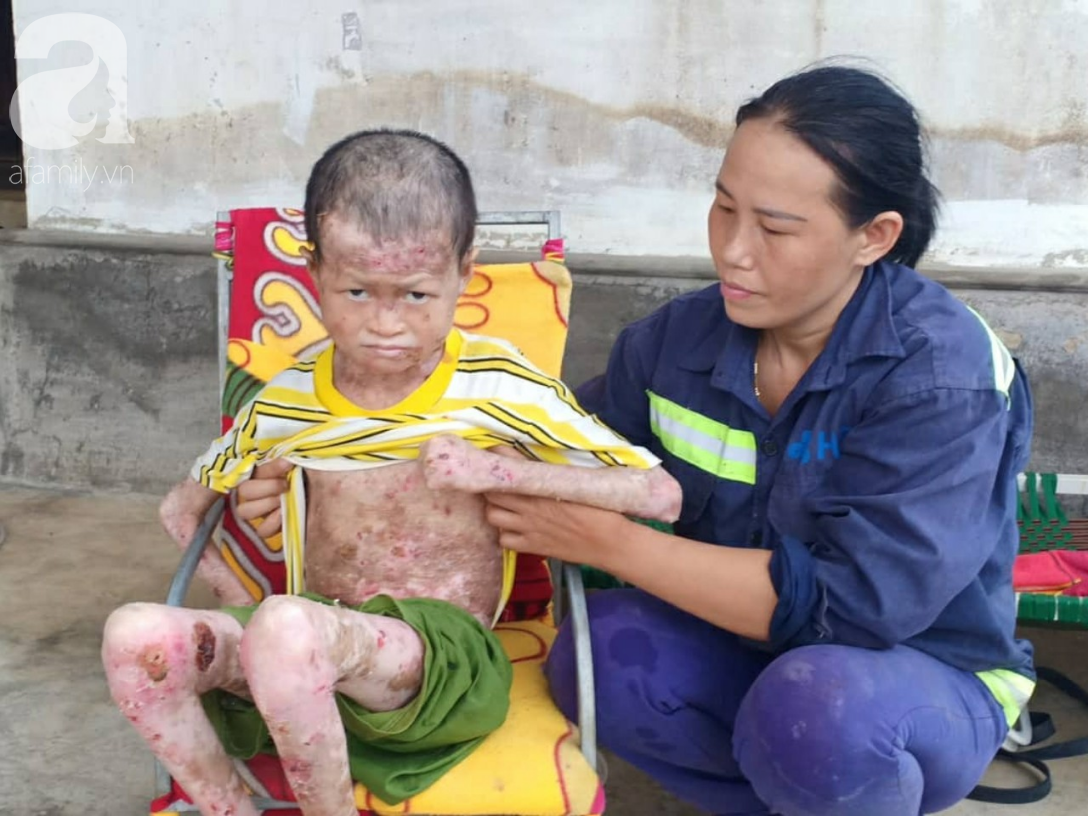 Tâm sự đau đớn của người rắn” 17 tuổi: Em còn sống ngày nào thì cha mẹ còn khổ thêm”-2