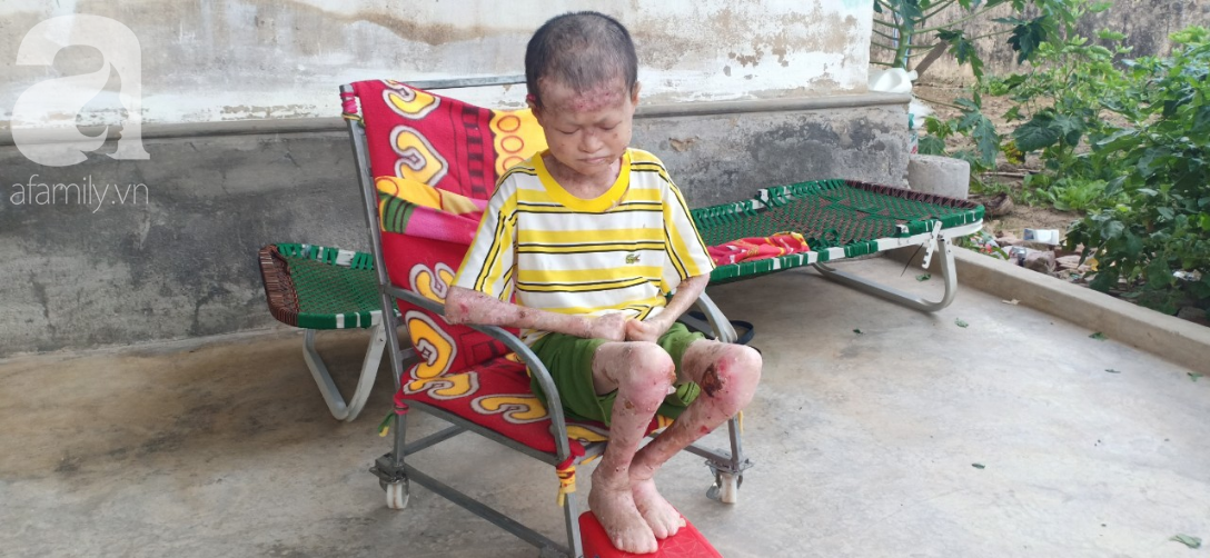 Tâm sự đau đớn của người rắn” 17 tuổi: Em còn sống ngày nào thì cha mẹ còn khổ thêm”-5