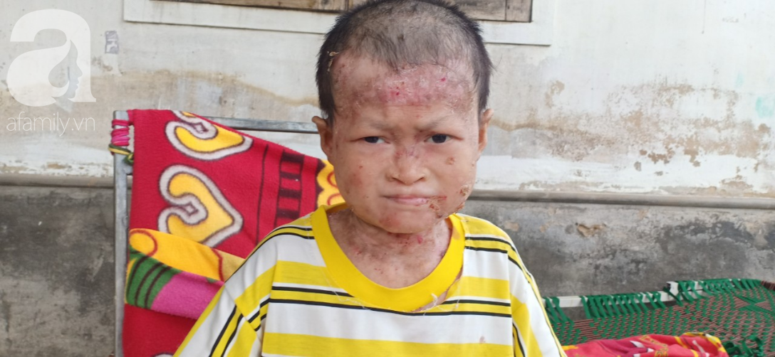 Tâm sự đau đớn của người rắn” 17 tuổi: Em còn sống ngày nào thì cha mẹ còn khổ thêm”-6