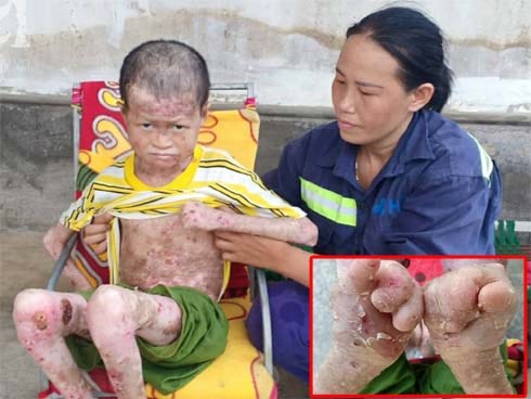 Tâm sự đau đớn của “người rắn” 17 tuổi: “Em còn sống ngày nào thì cha mẹ còn khổ thêm”
