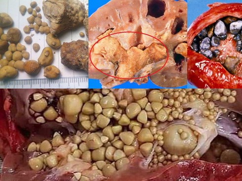 Đừng chủ quan, đau lưng âm ỉ cũng có thể tiểu ra sỏi