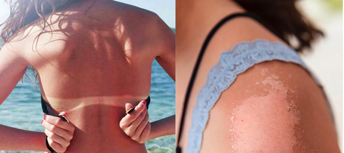 6 tuýp kem nhả nắng này chính là siêu cứu tinh cho các chị em da bị bắt nắng và thâm sạm-2