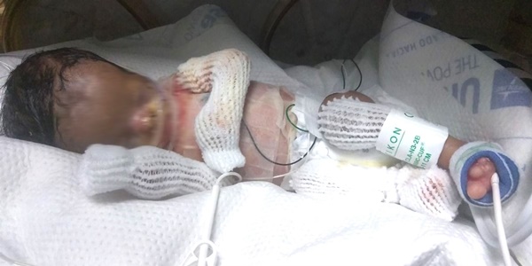 Bé trai bị bệnh viện trả về vì bẩm sinh không có da, 8 tháng sau điều kỳ diệu đã đến-3