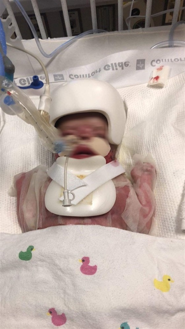 Bé trai bị bệnh viện trả về vì bẩm sinh không có da, 8 tháng sau điều kỳ diệu đã đến-4