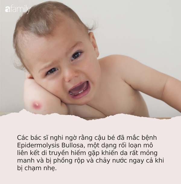 Bé trai bị bệnh viện trả về vì bẩm sinh không có da, 8 tháng sau điều kỳ diệu đã đến-5