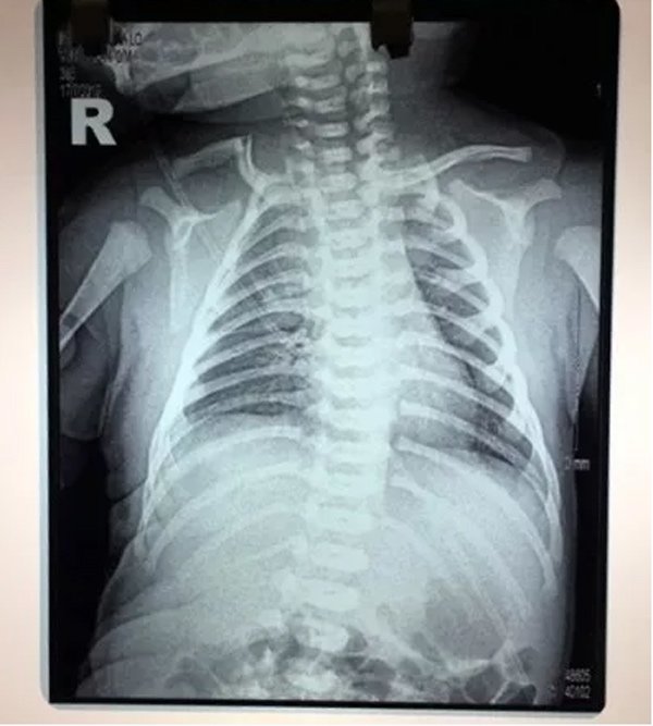 Chưa kịp vui mừng vì con chào đời, sản phụ choáng váng nhận tin con bị gãy xương đòn-3