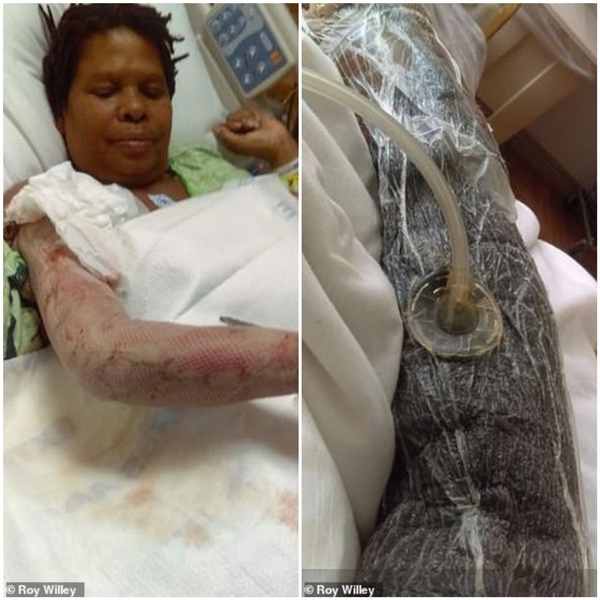 Người phụ nữ bị nhiễm vi khuẩn ăn thịt người sau khi đi công viên nước-1