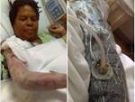 Hàng chục người nhập viện Bạch Mai do nhiễm vi khuẩn ăn thịt người-2