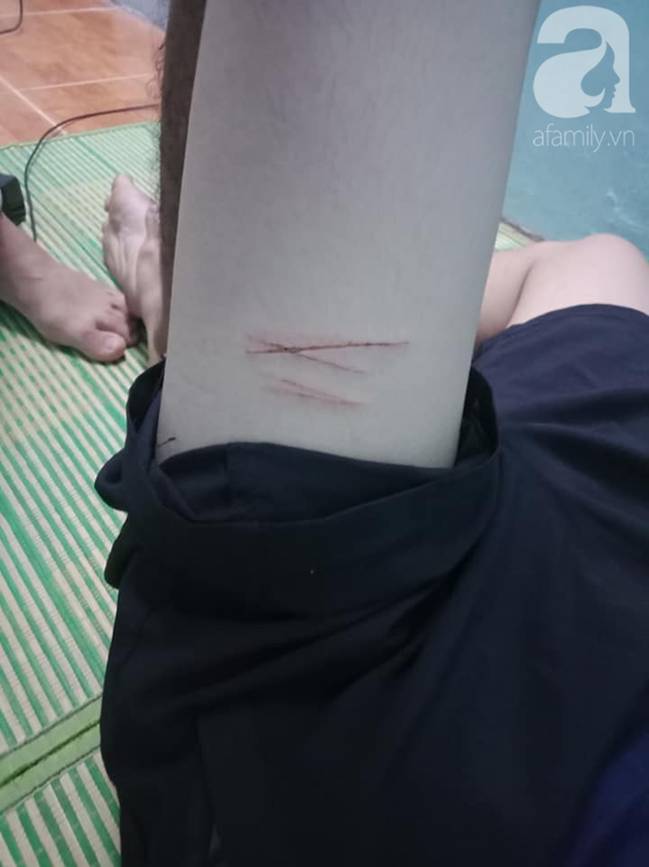 Nam sinh viên bị 4 kẻ lạ mặt tấn công, rạch đùi cướp tài sản ngay trước hẻm nhà trọ-2