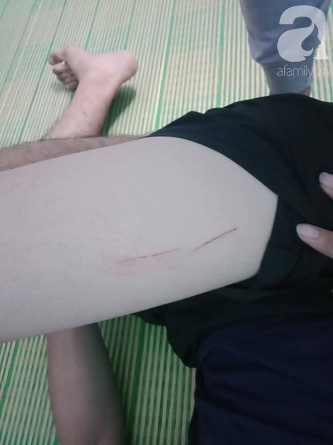 Nam sinh viên bị 4 kẻ lạ mặt tấn công, rạch đùi cướp tài sản ngay trước hẻm nhà trọ-4