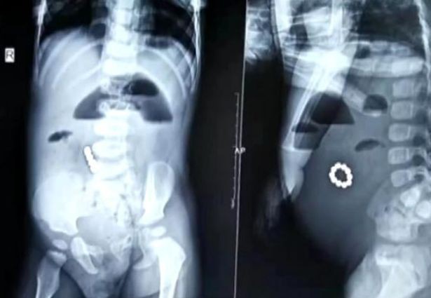 Hiểm họa khó lường từ đồ chơi trẻ em: Cha mẹ chủ quan, con nhập viện hoặc tử vong trong phút chốc-4