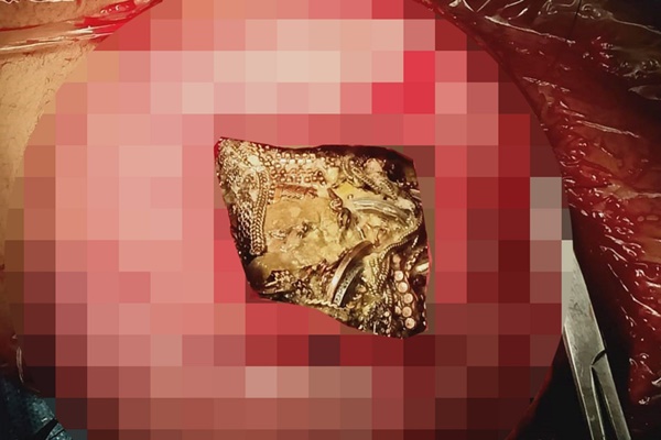 Các bác sĩ giật mình” khi phát hiện gần 1,6kg trang sức cùng 1,5 tỷ đồng nằm gọn trong dạ dày người phụ nữ bởi một hội chứng bí ẩn-2