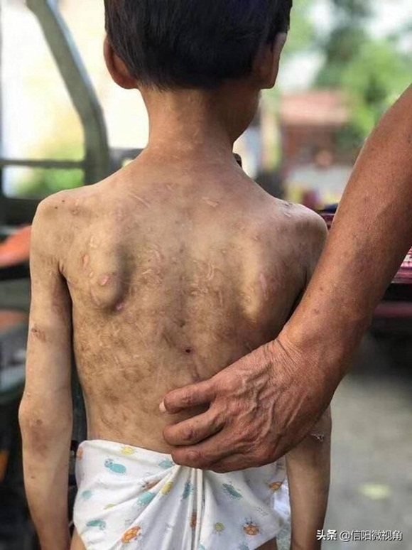 Cháu không nghe lời bị bà nội bạo hành, khi nhìn thấy vết thương trên cơ thể ai cũng phẫn nộ muốn bỏ tù người bà ngay lập tức-1