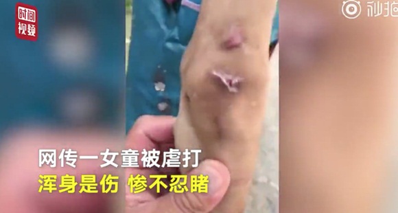 Cháu không nghe lời bị bà nội bạo hành, khi nhìn thấy vết thương trên cơ thể ai cũng phẫn nộ muốn bỏ tù người bà ngay lập tức-3