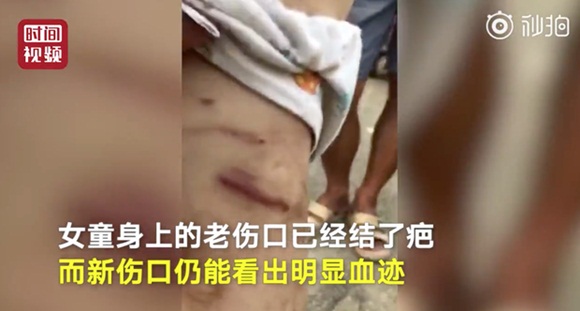 Cháu không nghe lời bị bà nội bạo hành, khi nhìn thấy vết thương trên cơ thể ai cũng phẫn nộ muốn bỏ tù người bà ngay lập tức-4