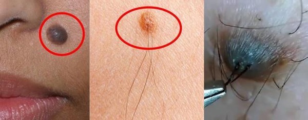 Nốt ruồi ở vị trí nào cảnh báo bệnh ung thư?-1