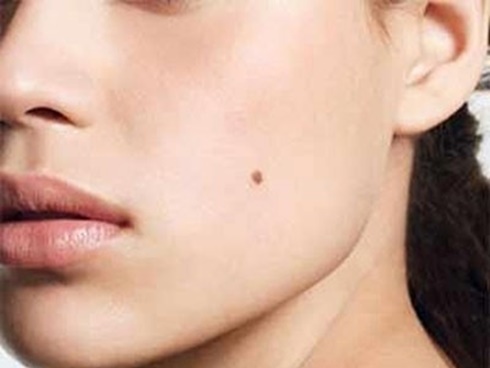 Tẩy nốt ruồi lại mọc, người đàn ông phải khoét mũi vì ung thư-2