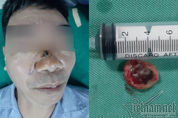 Tẩy nốt ruồi lại mọc, người đàn ông phải khoét mũi vì ung thư-1