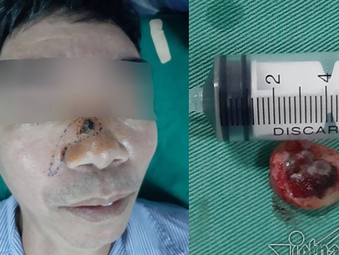 5 tín hiệu từ nốt ruồi cảnh báo ung thư đang tiềm ẩn dưới làn da-6