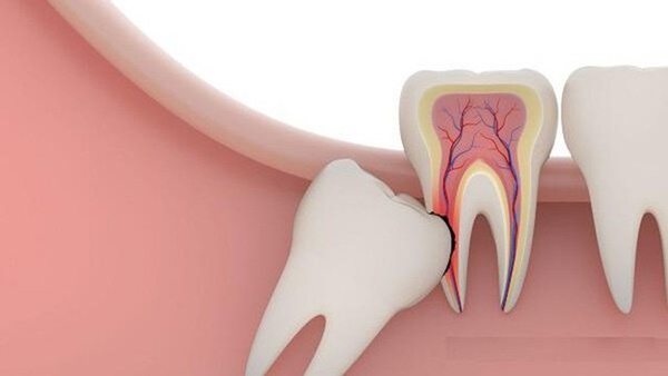 Mất mạng vì nhổ răng, chuyên gia cảnh báo 4 thời điểm tuyệt đối không nhổ răng khôn-3