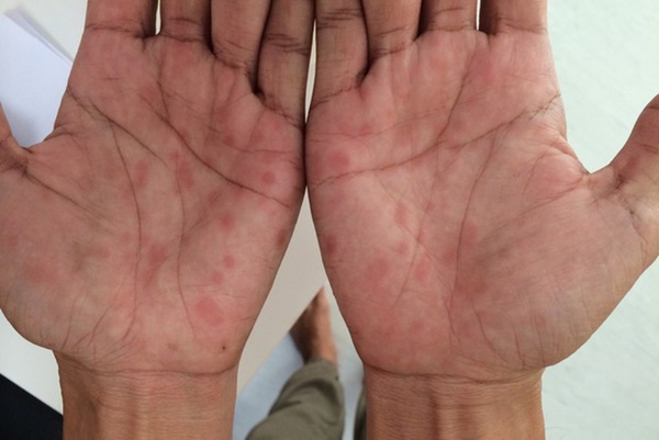 Hà Nội: Bé trai 13 tuổi mắc bệnh giang mai do quan hệ tình dục không an toàn-1