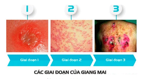 Hà Nội: Bé trai 13 tuổi mắc bệnh giang mai do quan hệ tình dục không an toàn-3