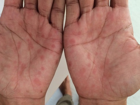 Giám đốc bị tâm thần vì mắc giang mai nhưng không chữa, nguyên nhân không ai ngờ tới-4