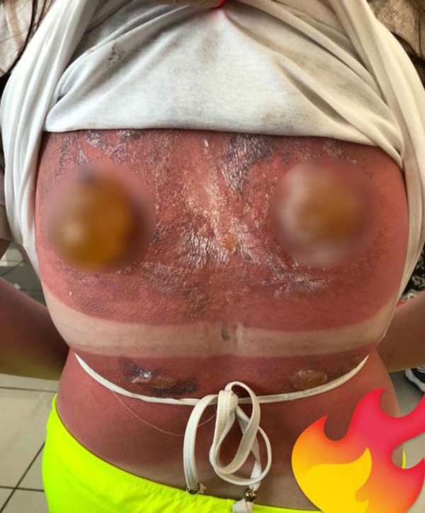 Cô gái 16 tuổi bị bỏng nắng nghiêm trọng, khiến vùng lưng nổi đầy mụn nước siêu to khổng lồ-2