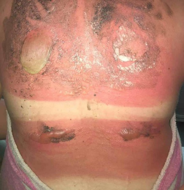 Cô gái 16 tuổi bị bỏng nắng nghiêm trọng, khiến vùng lưng nổi đầy mụn nước siêu to khổng lồ-4