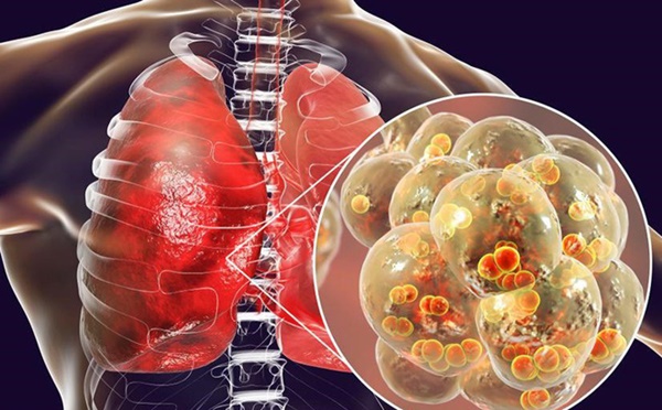 4 dấu hiệu cảnh báo căn bệnh ung thư phổi đang tấn công cơ thể, đừng coi thường kẻo mất mạng-1