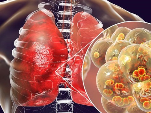 Người phụ nữ mắc ung thư phổi 10 năm vẫn sống khỏe vì làm 3 việc để tự cứu mình-4