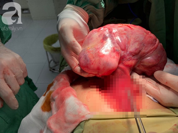 Người phụ nữ mang khối u gan khủng xâm lấn đến đại tràng phải phẫu thuật gấp: Thấy tăng cân nhanh nên đi khám ngay-1