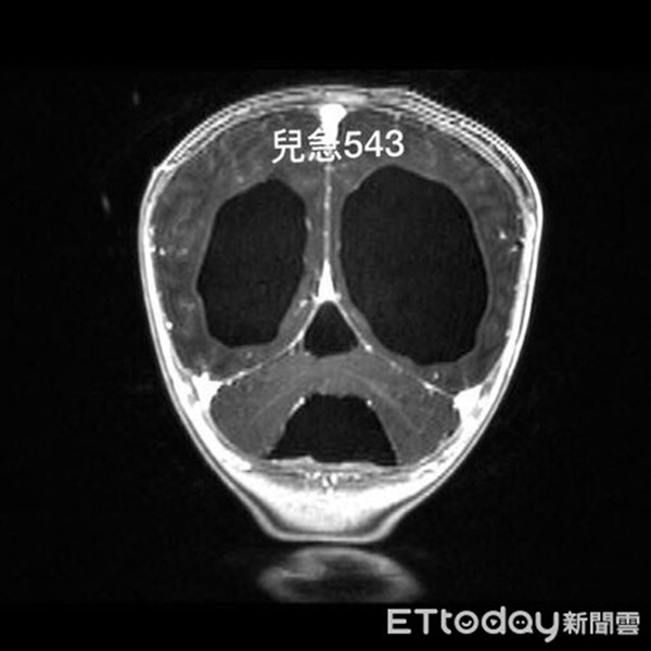 Bé 5 tháng tuổi nôn liên tiếp 2 ngày, vòng đầu to thấy rõ, có nguy cơ tử đột tử vì mắc căn bệnh này-1