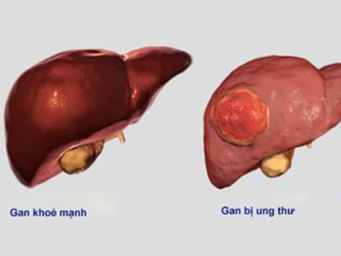 Ung thư gan VN xếp thứ 4 thế giới, những cách chữa mới nhất bệnh nhân cần biết