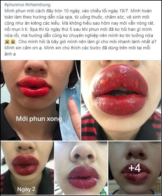 Tin tưởng phun xăm tại spa gần nhà và kết quả nhận lại là đôi môi sưng méo miệng, nổi mụn chi chít-1