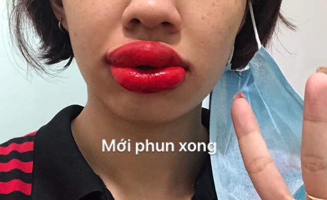 Tin tưởng phun xăm tại spa gần nhà và kết quả nhận lại là đôi môi sưng méo miệng, nổi mụn chi chít-2