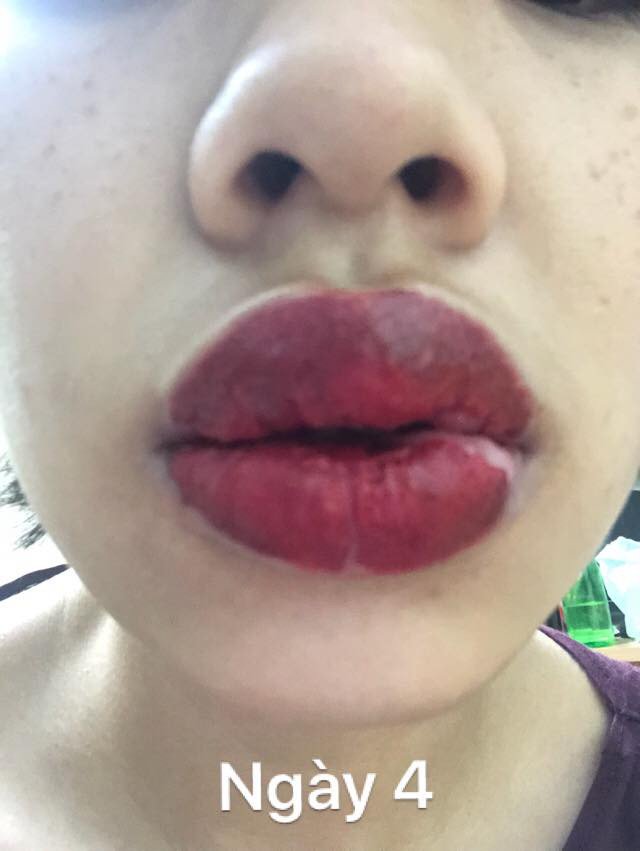 Tin tưởng phun xăm tại spa gần nhà và kết quả nhận lại là đôi môi sưng méo miệng, nổi mụn chi chít-5