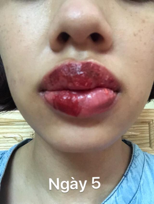 Tin tưởng phun xăm tại spa gần nhà và kết quả nhận lại là đôi môi sưng méo miệng, nổi mụn chi chít-6