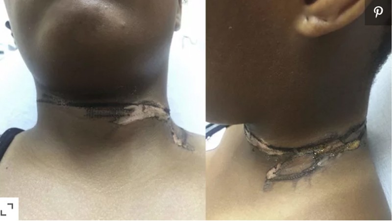 Chỉ vì thói quen này khi đi ngủ mà người phụ nữ bị bỏng cổ nghiêm trọng, ai mắc phải cần tránh ngay-1