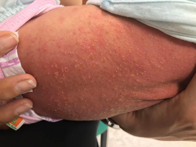 Bé sơ sinh toàn thân tấy đỏ, chảy mủ vì sai lầm rất nhiều người Việt đang làm sau sinh-1