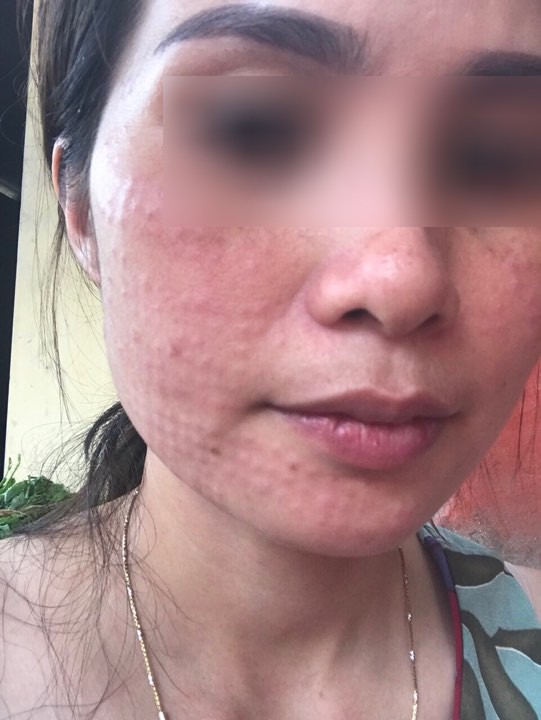 Tiêm collagen làm đẹp da, làn da người phụ nữ nổi sần khắp mặt phải cầu cứu bác sĩ-1
