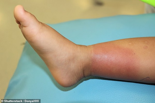 Bệnh nhiễm trùng giết chết 5.000 người Úc mỗi năm, ở Việt Nam cũng có: Đây là cách phát hiện sớm nhất để tự cứu mình-3