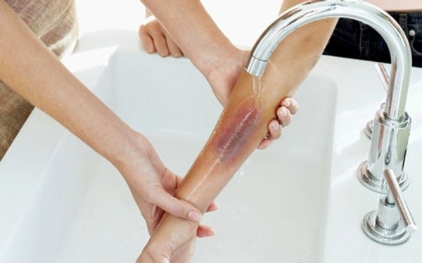 Bé 2 tuổi ngã vào chảo dầu sôi, hành động tưởng cứu nguy của cha mẹ hóa ra hại con-3