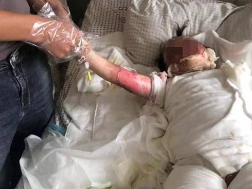 Bé 2 tuổi ngã vào chảo dầu sôi, hành động tưởng cứu nguy của cha mẹ hóa ra hại con