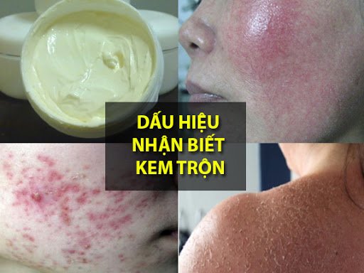 Kem trộn là gì? Những tác hại và cách nhận biết kem trộn trắng da-3