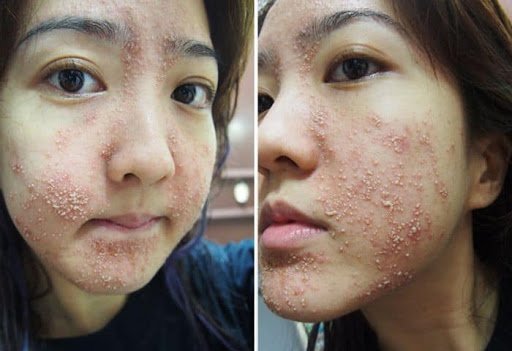 Kem trộn là gì? Những tác hại và cách nhận biết kem trộn trắng da-4