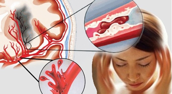 5 dấu hiệu cảnh báo chứng tắc mạch máu, đề phòng tử thần gõ cửa, nguy hiểm nhất là số 1-1