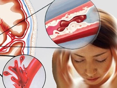 5 dấu hiệu cảnh báo chứng tắc mạch máu, đề phòng tử thần gõ cửa, nguy hiểm nhất là số 1