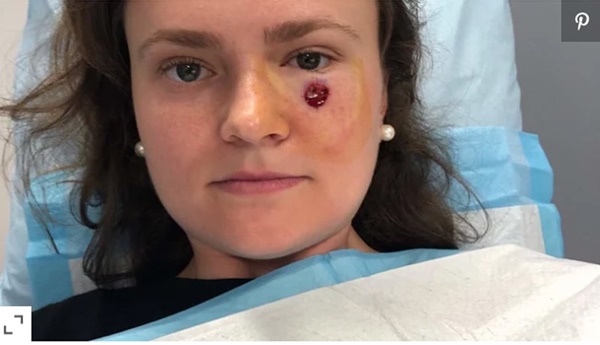 Chỉ từ một nốt mụn thông thường, cô gái trẻ tá hỏa khi bác sĩ khẳng định bị ung thư da-2